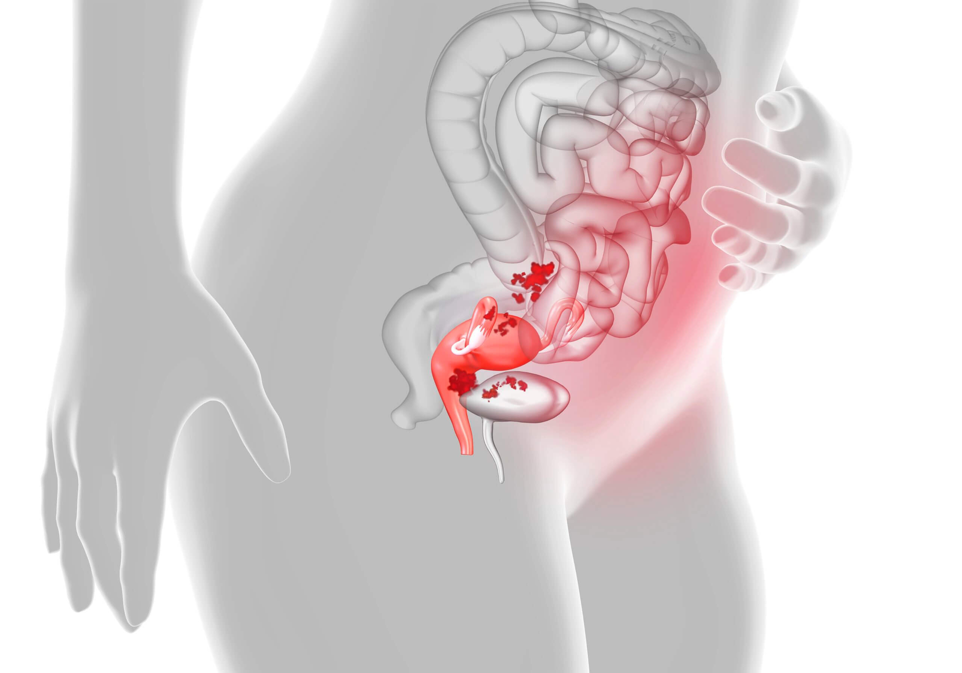 Endometrioza: Shkaqet, Simptomat, Diagnoza dhe Trajtimi