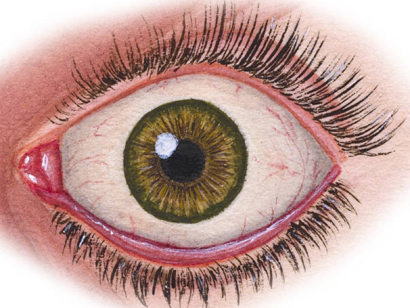 Efekti i diabetit në sy: Retinopatia Diabetike