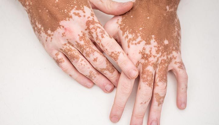 Çfarë është Vitiligo?