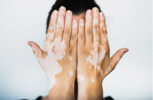 Çfarë është Vitiligo?