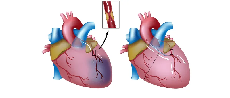 Bypass kardiak vs. stent: Cila është zgjidhja e duhur? Bypass kardiak vs. stent: Cila është zgjidhja e duhur?