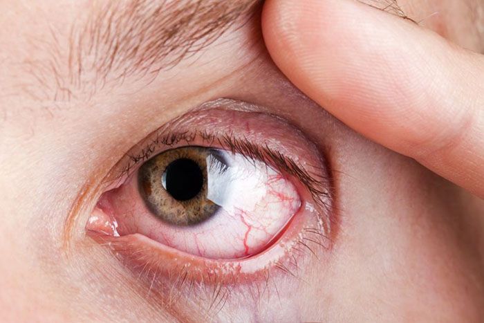 Si Ndikon Diabeti në Shëndetin e Syve? Si Ndikon Diabeti në Shëndetin e Syve?