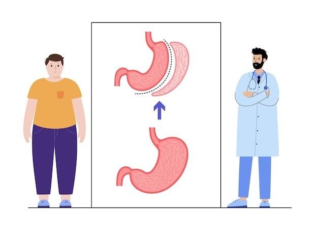 Obeziteti & Operacioni Gastric Sleeve në Turqi si Zgjidhje Afatgjatë Obeziteti & Operacioni Gastric Sleeve në Turqi si Zgjidhje Afatgjatë