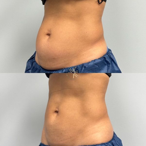 Abdominoplastika: Bark më i Rrafshët dhe Muskuj më të Fortë Abdominoplastika: Bark më i Rrafshët dhe Muskuj më të Fortë