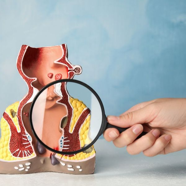 Trajtimi i hemorroideve në Turqi: teknologji moderne dhe çmime të arsyeshme Trajtimi i hemorroideve në Turqi: teknologji moderne dhe çmime të arsyeshme